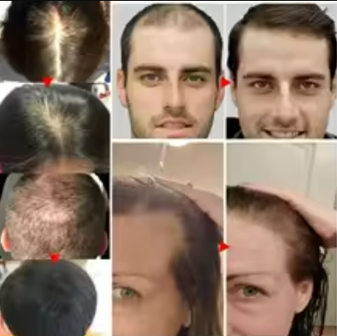 Laca para el cabello con biotina - Compra 1 y llévate 2